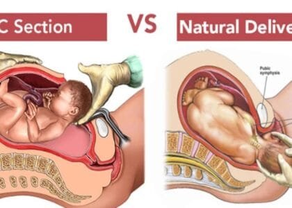c sectionvs normal delivery 1024x440.png