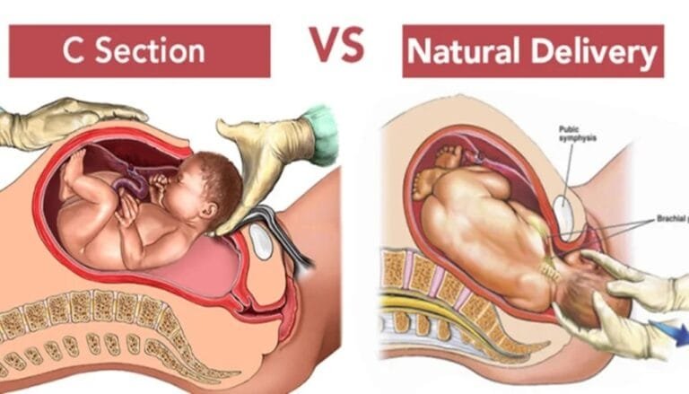 C-Section & Normal Delivery Specialist